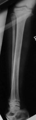 Salter 1 tibia distal -1