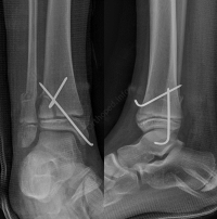 Fracture Salter 2 extrémité distale tibia - radios post-opératoires