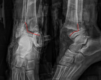 Fracture Salter 2 extrémité distale tibia - radios initiales
