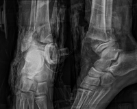 Salter 2 tibia distal -1