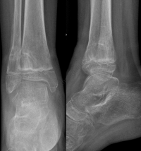 Fracture Salter 2 extrémité distale tibia - radios à 2 mois