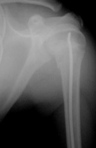 Salter 2 humérus proximal