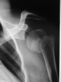 Salter 2 humérus proximal