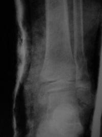 Fracture Salter 2 de l'extrémité distale du tibia