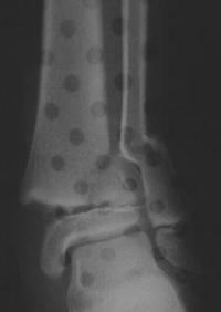 Salter 2 tibia distal - 2
