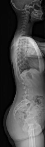 Radio préopératoire de Profil