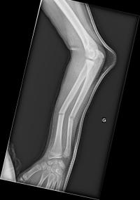 Fracture diaphysaire des 2 os de l'avant-bras. Radiographies initiales