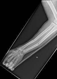 Fracture diaphysaire des 2 os de l'avant-bras. Radiographies initiales