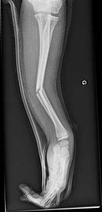 Fracture diaphysaire des 2 os de l'avant-bras. Radiographies initiales