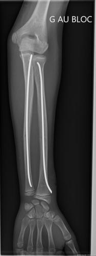 Fracture diaphysaire des 2 os de l'avant-bras.