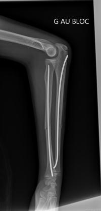 Fracture diaphysaire des 2 os de l'avant-bras.