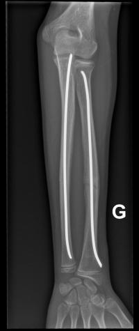 Fracture diaphysaire des 2 os de l'avant-bras.