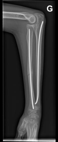 Fracture diaphysaire des 2 os de l'avant-bras.