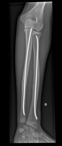 Fracture diaphysaire des 2 os de l'avant-bras.