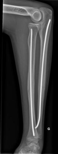 Fracture diaphysaire des 2 os de l'avant-bras.