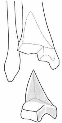 Fracture triplane du tibia Droit