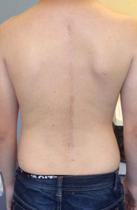 Aspect de la cicatrice à distance de l'intervention