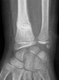 Fracture métaphysaire distale du radius  : radio de Face à J15