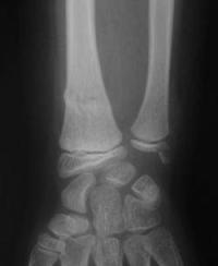 Fracture métaphysaire distale du radius : radio de Face initiale