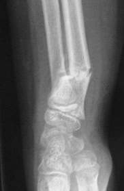 Fracture métaphysaire distale du radius : radio de Profil à J15