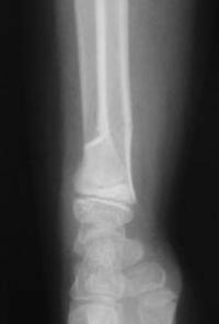 Fracture métaphysaire distale du radius : radio de Profil initiale