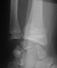 Salter 2 du radius distal - Radio de Face