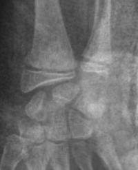 Salter 2 du radius distal