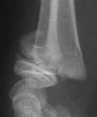 Salter 2 du radius distal - Radio de Profil