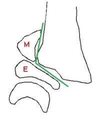 Salter 2 du radius distal - Schéma de Profil