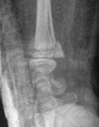 Salter 2 du radius distal
