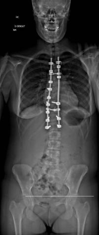 Scoliose thoracique Droite - cliché post-opératoire de Face