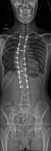 Scoliose thoracique D - Cliché post-opératoire de Face