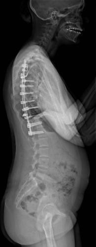 Scoliose thoracique Droite - cliché post-opératoire de Profil