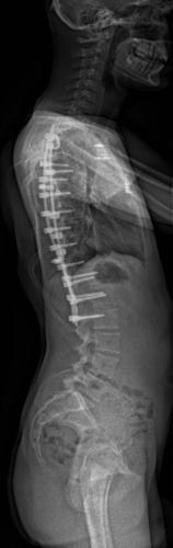 Scoliose thoracique D - Cliché post-opératoire de Profil