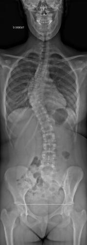 Scoliose Thoracique 2