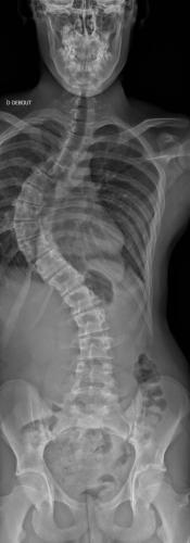 Scoliose thoracique D - Cliché pré-opératoire de Face