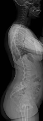 Scoliose thoracique Droite - cliché pré-opératoire de Profil