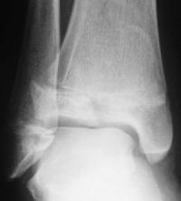 Fracture triplane du tibia Droit