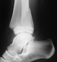 Fracture triplane du tibia Droit