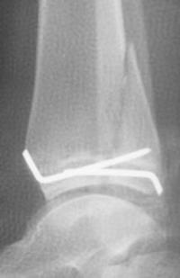 Fracture triplane du tibia Droit