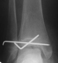 Fracture triplane du tibia Droit