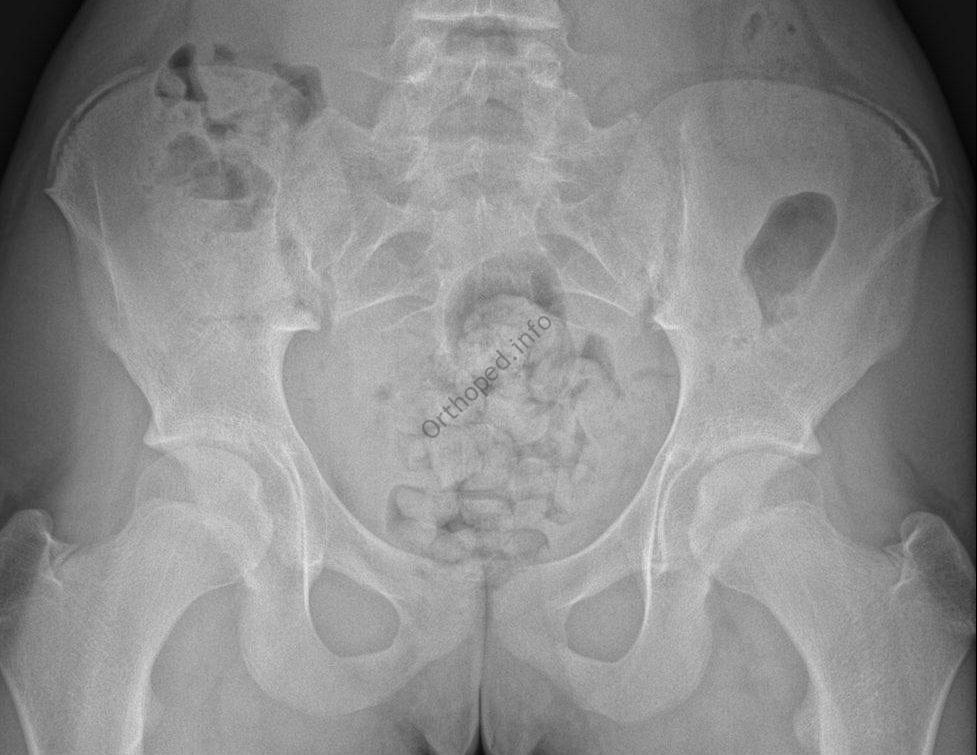 Test de Risser - Evaluation de la croissance résiduelle du rachis